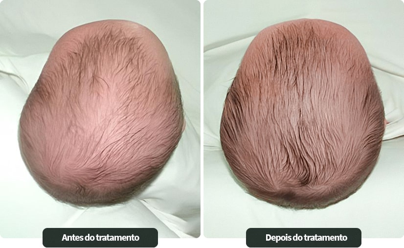 plagiocefalia posicional antes e depois tratamento