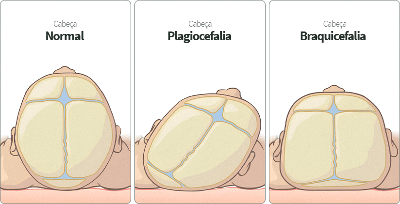 assimetrias cranianas
